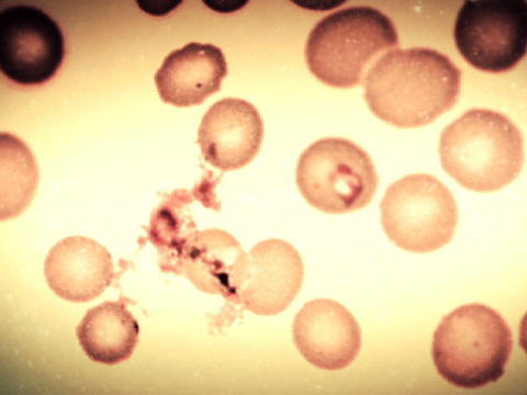 Monsters Inside Me: Babesiosis