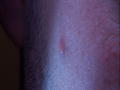  Popping a Pimple