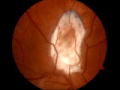 Monsters Inside Me: Tapeworm In The Eye