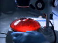 Monsters Inside Me: Breast Implant Infection