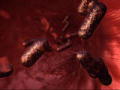 Monsters Inside Me: Rat Bite Fever