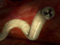 Monsters Inside Me: Coughing Up Worms