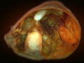 Monsters Inside Me: Ovarian Teratoma