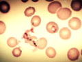 Monsters Inside Me: Babesiosis