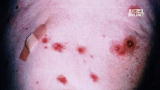 Monsters Inside Me: Eaten Alive by Bugs