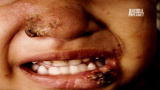 Monsters Inside Me: Face Eaten Off by Parasites