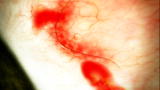 Monsters Inside Me: River Blindness