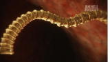 Monsters Inside Me: Meter-Long Tapeworm