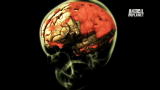 Monsters Inside Me: Tapeworm In My Brain