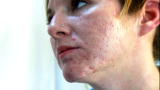 Embarrassing Bodies: Cystic Acne