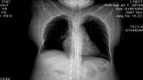 Lung Cancer: Lung Cancer Part 3