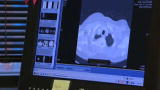 Metastatic Breast Cancer: Metastatic Breast Cancer Part 4
