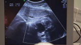 Baby Week Shorts: Bladder Blockage