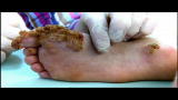 Embarrassing Bodies: Extreme Warts