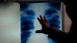Diagnosis Dead or Alive: Mouse Droppings Cause Rare Virus