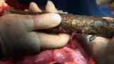 Shock Trauma: Impaled by a Tree