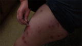 My Strange Addiction: Compulsive Scab Picking