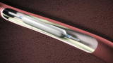 Diseases: Angioplasty