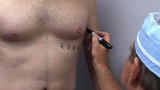 Surgeries: Reduce My Breasts