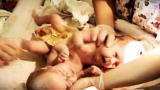 Separated Twins - Cojoined Twins Webisodes: Separated Twins