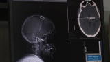 Physician Ed: Deep Brain Stimulation