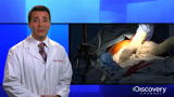 Physician Ed: HIPEC Shows Promise for Treatment of Abdominal Cancers