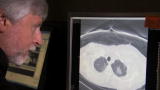 CME: Non-Small Cell Lung Cancer part 4