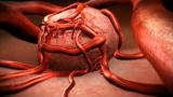 Patient Ed: Cancer Care Part 2