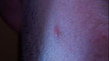 Time Warp: Popping a Pimple