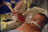 I Was Bitten: Rattlesnake Compartment Syndrome