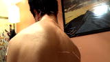 Elephant Man Autopsy: Acupuncture