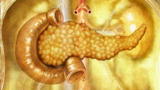 Greatest Discoveries: The Invention of Insulin