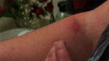 My Strange Addiction: Compulsive Scab Picking