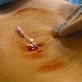 Body Invaders: Injection Treatment