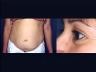 Body Work: Tummy Tuck