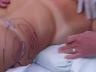 Body Work: Liposuction