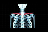Human Mutants: Mutation Arnold Syndrome