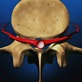 Body Invaders: Backache: Back Surgery