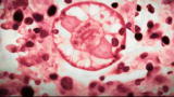 Monsters Inside Me: Baylisascaris, aka Raccoon Roundworm
