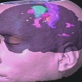 Surgery Saved My Life: Brain Road Map