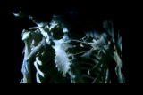Human Mutants: FOP Skeleton Mutation