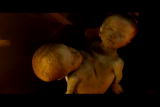 Human Mutants: Conjoined Twin Babies