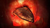 Monsters Inside Me: The Lung Fluke