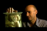 Human Mutants: Cephalothoracoiliopagus Twins