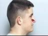 Plastic Surgery: Personal Stories: Ryan's Nose Surgery