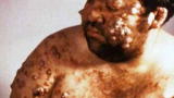 Monsters Inside Me: Flesh-Eating Parasite